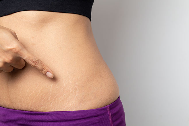 4 Ways to Flaunt Your Stretch Marks